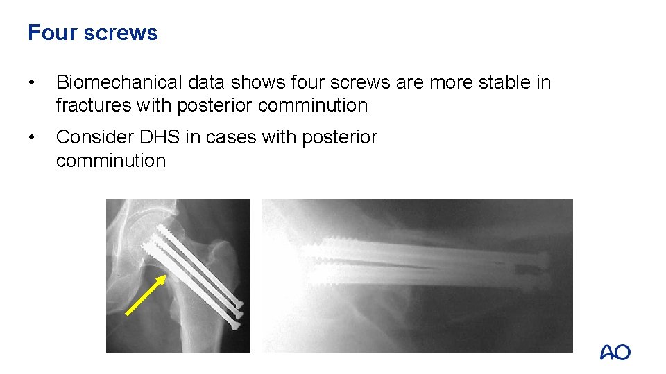 Four screws • Biomechanical data shows four screws are more stable in fractures with