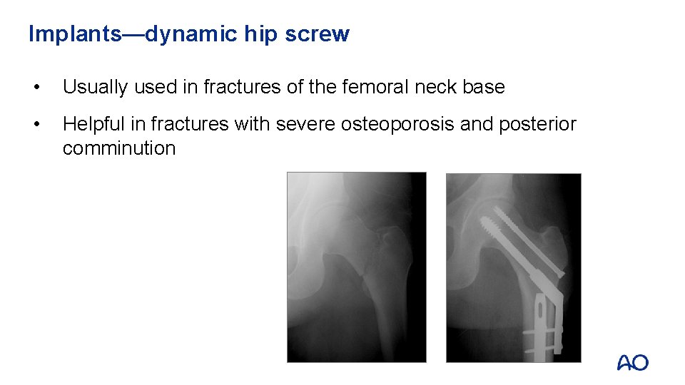 Implants—dynamic hip screw • Usually used in fractures of the femoral neck base •