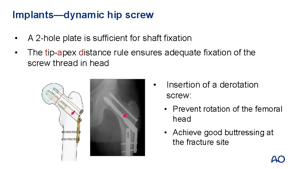 Implants—dynamic hip screw • A 2 -hole plate is sufficient for shaft fixation •