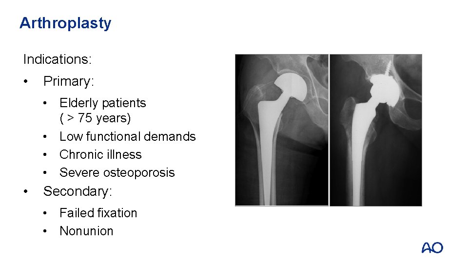 Arthroplasty Indications: • Primary: • Elderly patients ( > 75 years) • Low functional