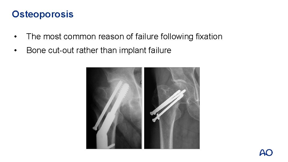 Osteoporosis • The most common reason of failure following fixation • Bone cut-out rather