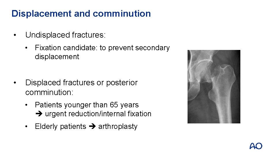 Displacement and comminution • Undisplaced fractures: • Fixation candidate: to prevent secondary displacement •