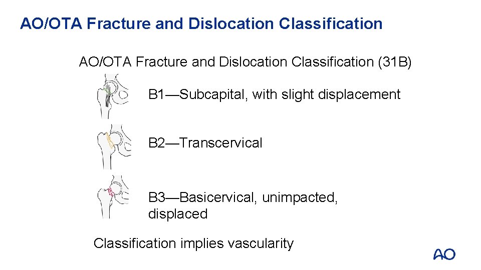 AO/OTA Fracture and Dislocation Classification (31 B) B 1—Subcapital, with slight displacement B 2—Transcervical