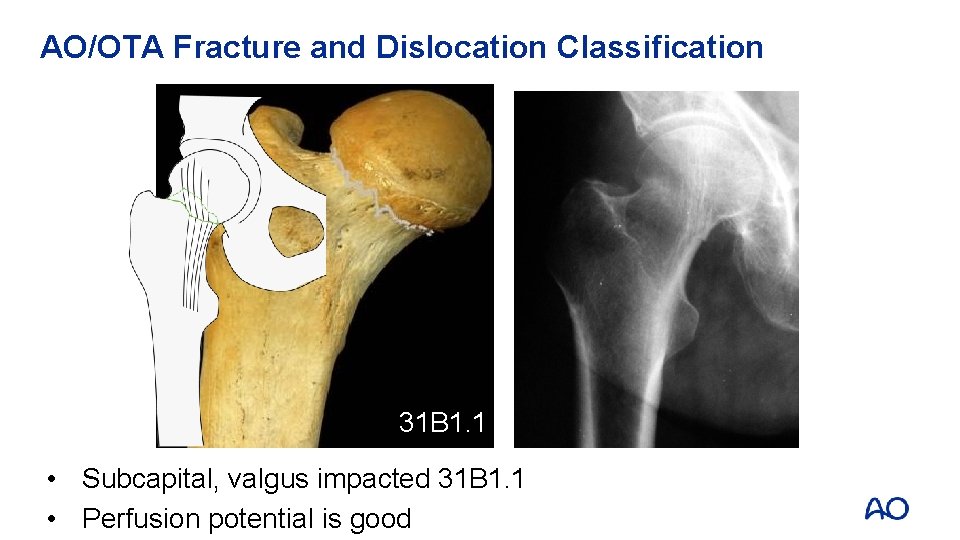 AO/OTA Fracture and Dislocation Classification 31 B 1. 1 • Subcapital, valgus impacted 31