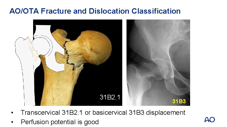 AO/OTA Fracture and Dislocation Classification 31 B 2. 1 • • 31 B 3