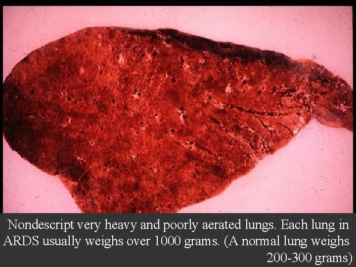 Nondescript very heavy and poorly aerated lungs. Each lung in ARDS usually weighs over