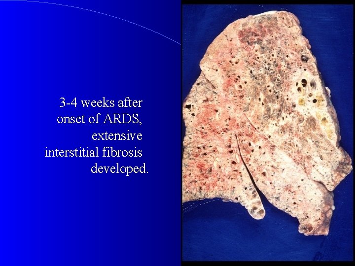 3 -4 weeks after onset of ARDS, extensive interstitial fibrosis developed. 