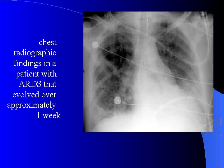 chest radiographic findings in a patient with ARDS that evolved over approximately 1 week