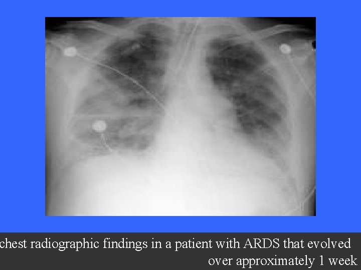 chest radiographic findings in a patient with ARDS that evolved over approximately 1 week