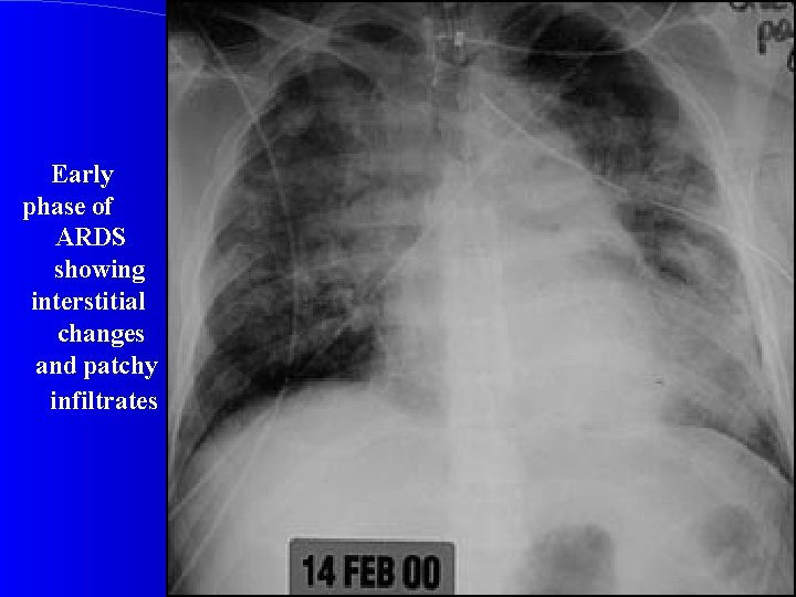 Early phase of ARDS showing interstitial changes and patchy infiltrates 