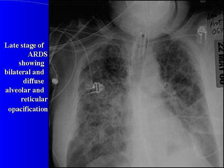 Late stage of ARDS showing bilateral and diffuse alveolar and reticular opacification 