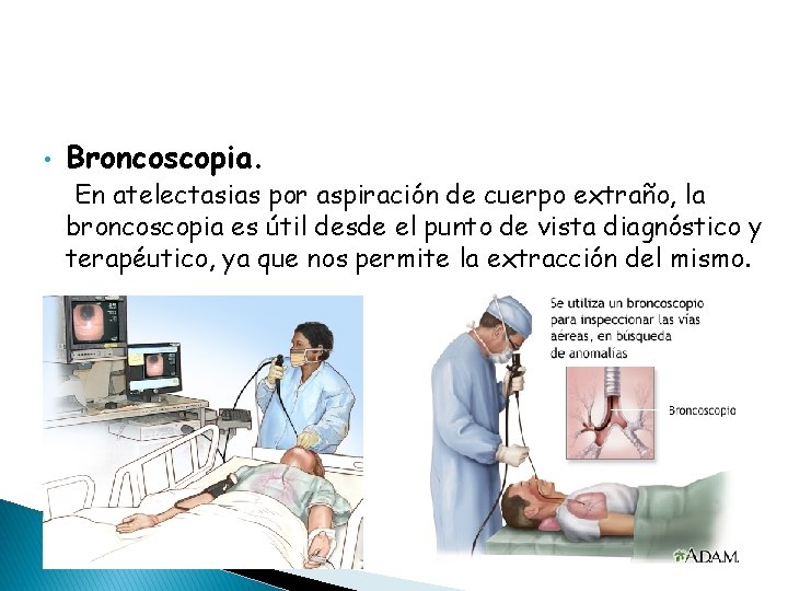  • Broncoscopia. En atelectasias por aspiración de cuerpo extraño, la broncoscopia es útil