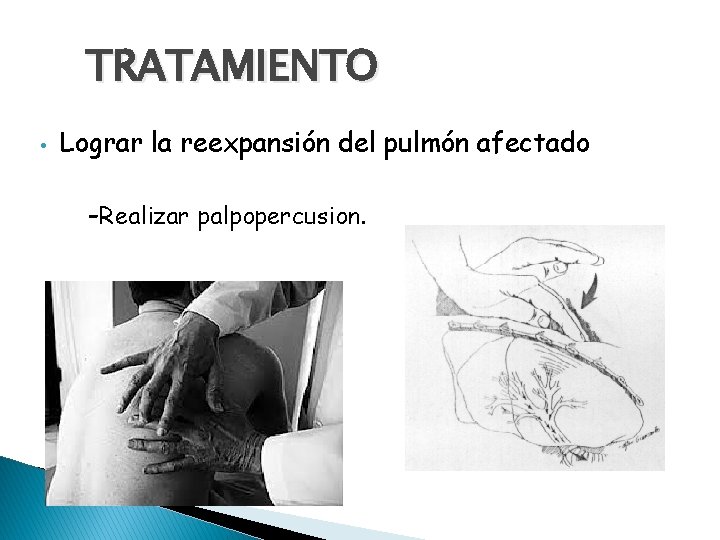 TRATAMIENTO • Lograr la reexpansión del pulmón afectado -Realizar palpopercusion. 