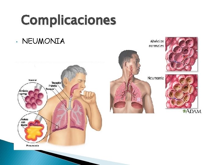 Complicaciones • NEUMONIA 