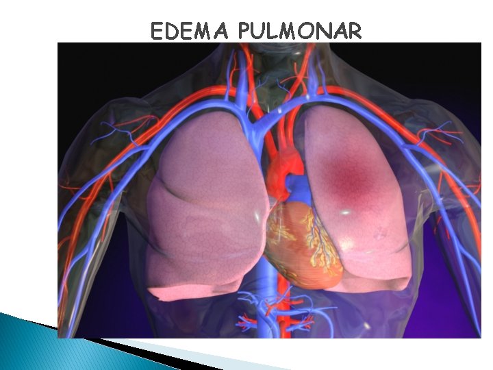 EDEMA PULMONAR 