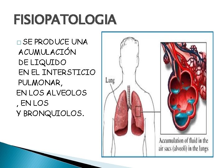 FISIOPATOLOGIA � SE PRODUCE UNA ACUMULACIÓN DE LIQUIDO EN EL INTERSTICIO PULMONAR, EN LOS