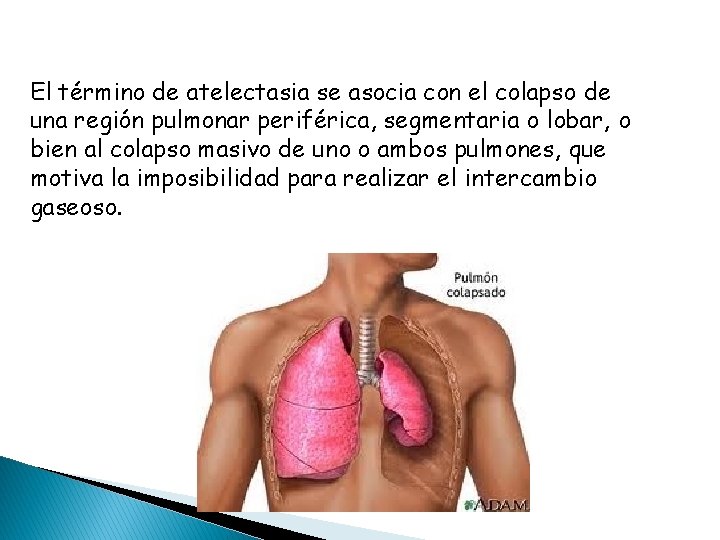 El término de atelectasia se asocia con el colapso de una región pulmonar periférica,