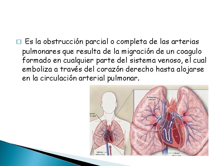 � Es la obstrucción parcial o completa de las arterias pulmonares que resulta de
