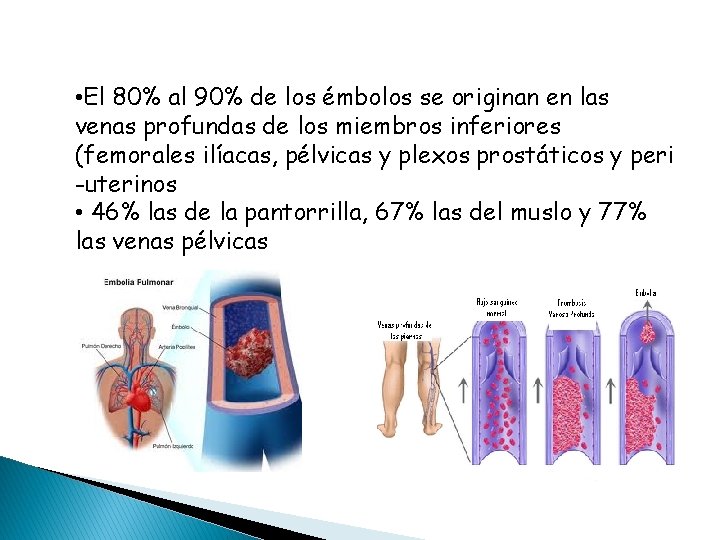  • El 80% al 90% de los émbolos se originan en las venas