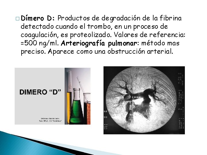 � Dímero D: Productos de degradación de la fibrina detectado cuando el trombo, en
