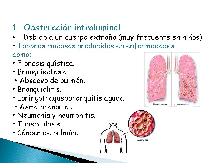 1. Obstrucción intraluminal • Debido a un cuerpo extraño (muy frecuente en niños) •