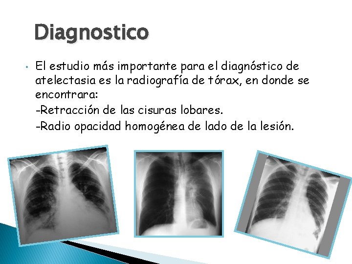 Diagnostico • El estudio más importante para el diagnóstico de atelectasia es la radiografía