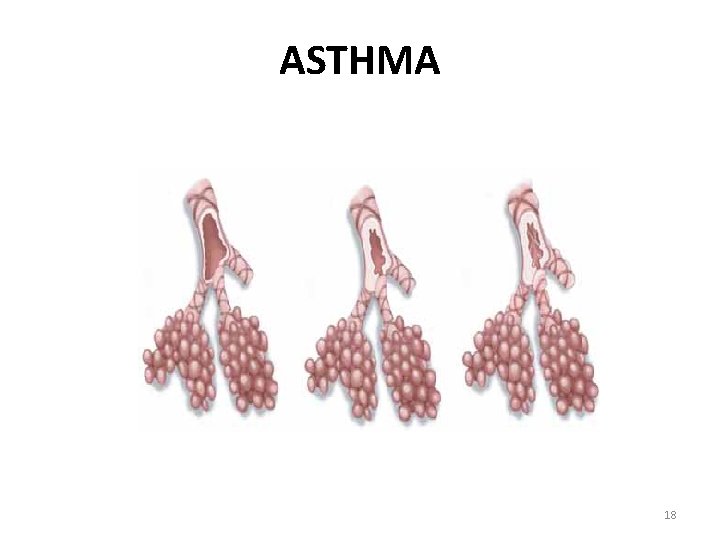 ASTHMA 18 
