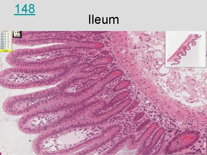 148 Ileum 