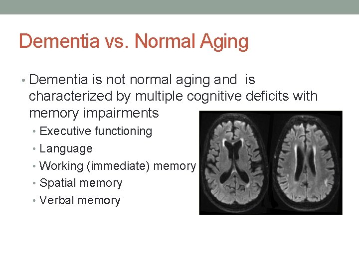 Dementia vs. Normal Aging • Dementia is not normal aging and is characterized by