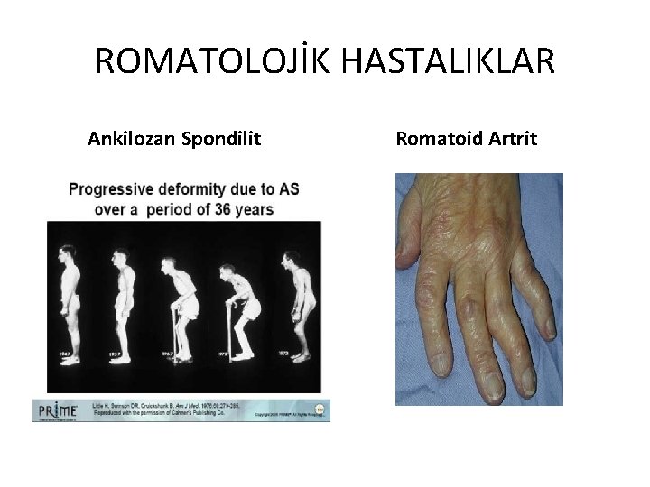 ROMATOLOJİK HASTALIKLAR Ankilozan Spondilit Romatoid Artrit 