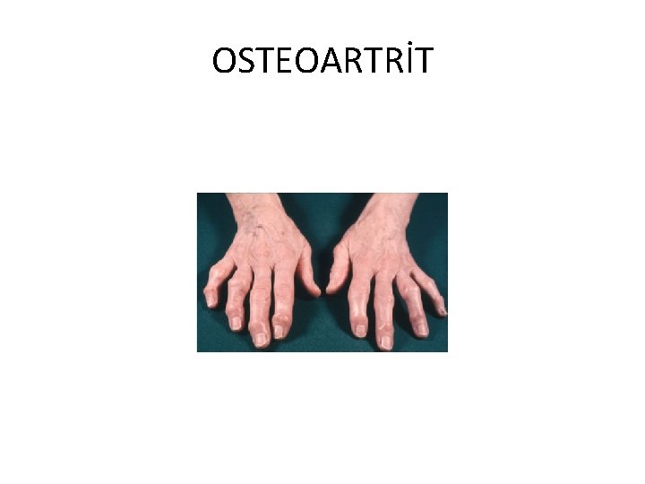 OSTEOARTRİT 