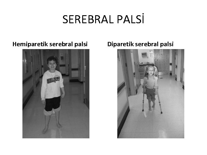 SEREBRAL PALSİ Hemiparetik serebral palsi Diparetik serebral palsi 