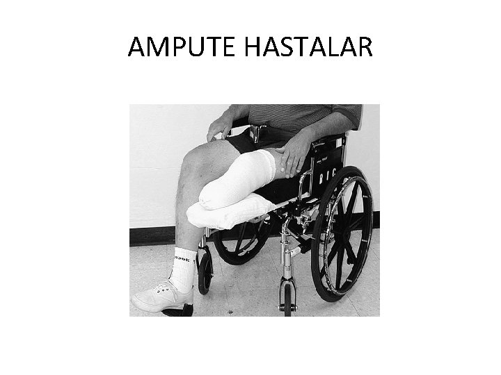 AMPUTE HASTALAR 