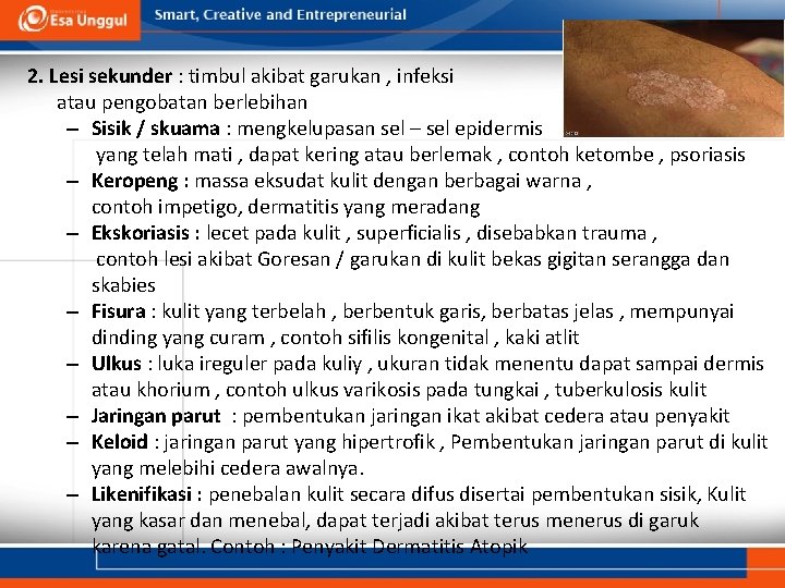 2. Lesi sekunder : timbul akibat garukan , infeksi atau pengobatan berlebihan – Sisik