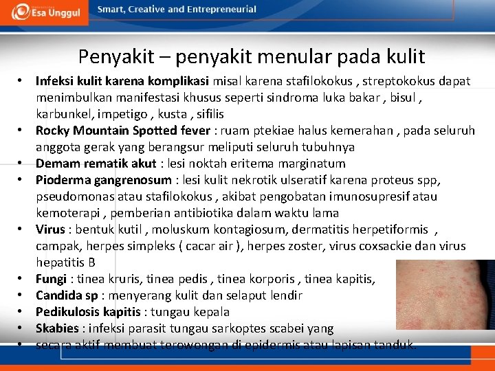 Penyakit – penyakit menular pada kulit • Infeksi kulit karena komplikasi misal karena stafilokokus