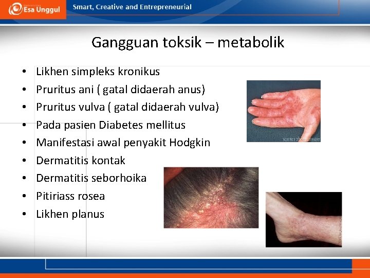 Gangguan toksik – metabolik • • • Likhen simpleks kronikus Pruritus ani ( gatal