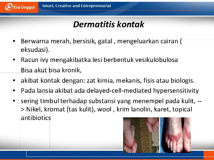 Dermatitis kontak • Berwarna merah, bersisik, gatal , mengeluarkan cairan ( eksudasi). • Racun