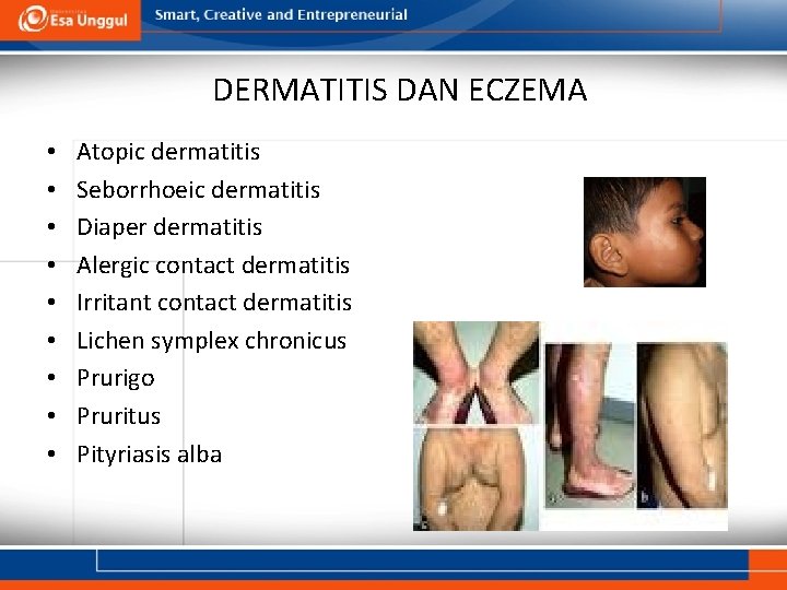 DERMATITIS DAN ECZEMA • • • Atopic dermatitis Seborrhoeic dermatitis Diaper dermatitis Alergic contact