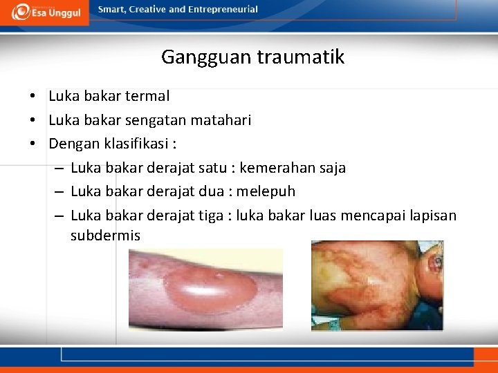 Gangguan traumatik • Luka bakar termal • Luka bakar sengatan matahari • Dengan klasifikasi