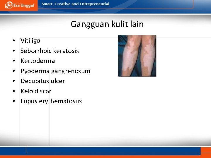 Gangguan kulit lain • • Vitiligo Seborrhoic keratosis Kertoderma Pyoderma gangrenosum Decubitus ulcer Keloid