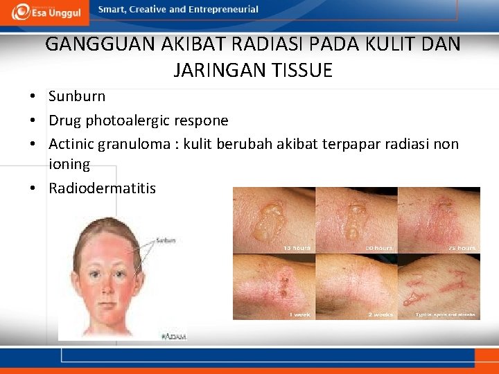 GANGGUAN AKIBAT RADIASI PADA KULIT DAN JARINGAN TISSUE • Sunburn • Drug photoalergic respone