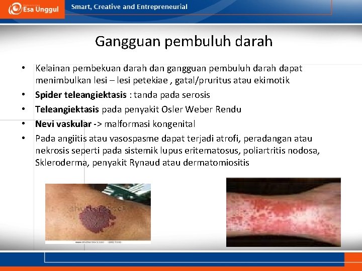 Gangguan pembuluh darah • Kelainan pembekuan darah dan gangguan pembuluh darah dapat menimbulkan lesi
