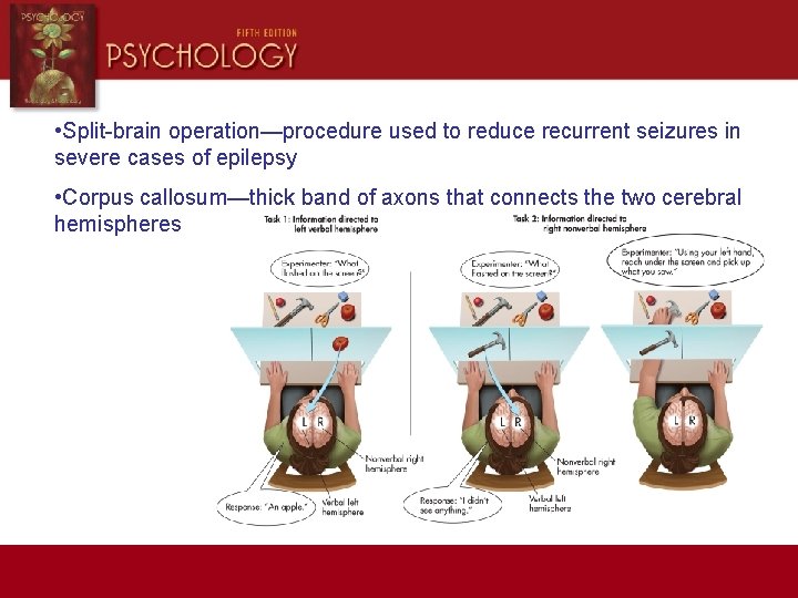  • Split-brain operation—procedure used to reduce recurrent seizures in severe cases of epilepsy
