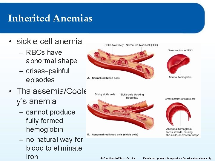 Inherited Anemias • sickle cell anemia – RBCs have abnormal shape – crises–painful episodes
