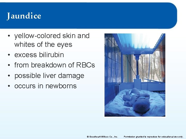 Jaundice • yellow-colored skin and whites of the eyes • excess bilirubin • from