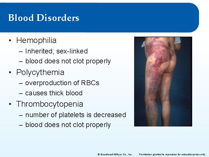 Blood Disorders • Hemophilia – Inherited; sex-linked – blood does not clot properly •