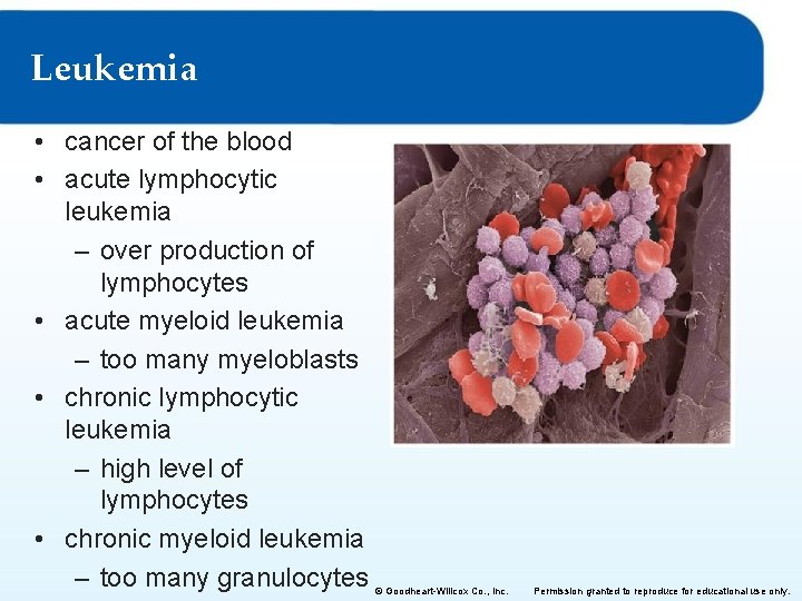 Leukemia • cancer of the blood • acute lymphocytic leukemia – over production of