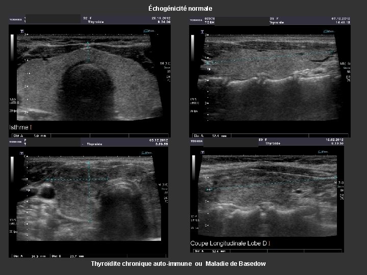 Échogénicité normale Thyroïdite chronique auto-immune ou Maladie de Basedow 