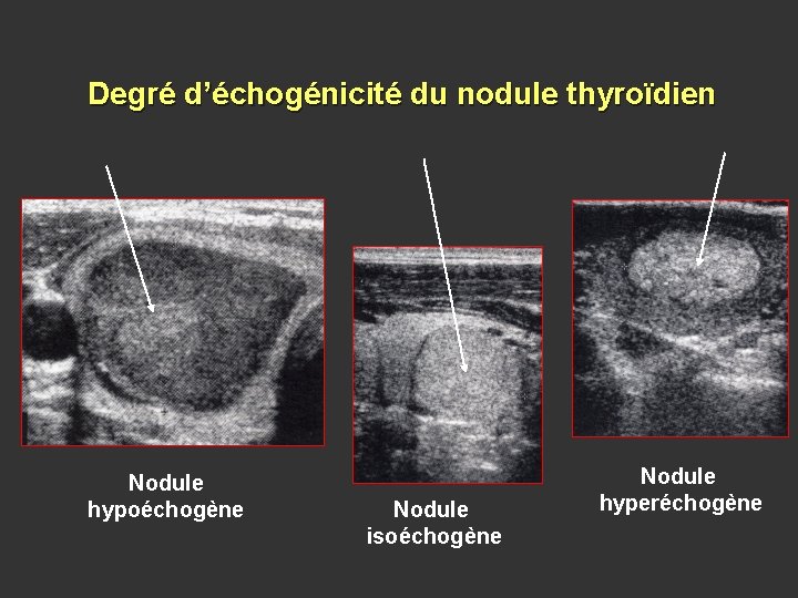 Degré d’échogénicité du nodule thyroïdien Nodule hypoéchogène Nodule isoéchogène Nodule hyperéchogène 