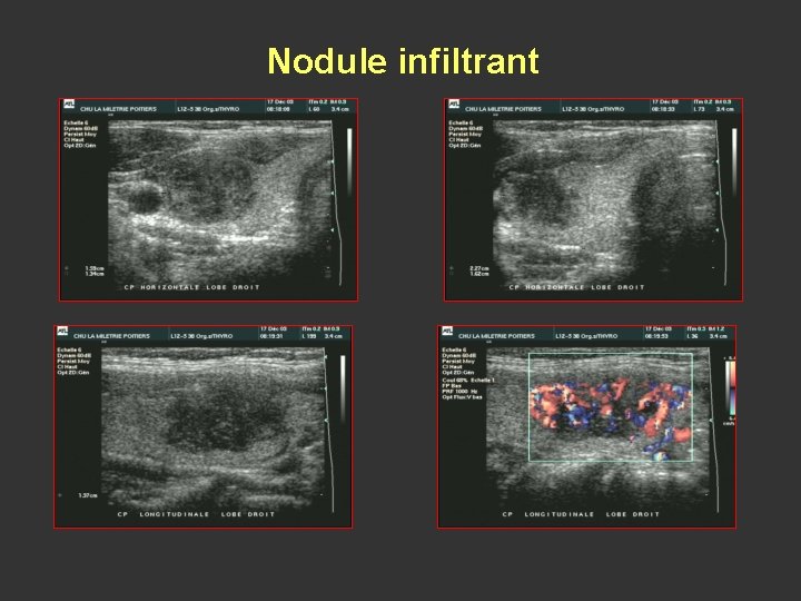 Nodule infiltrant 